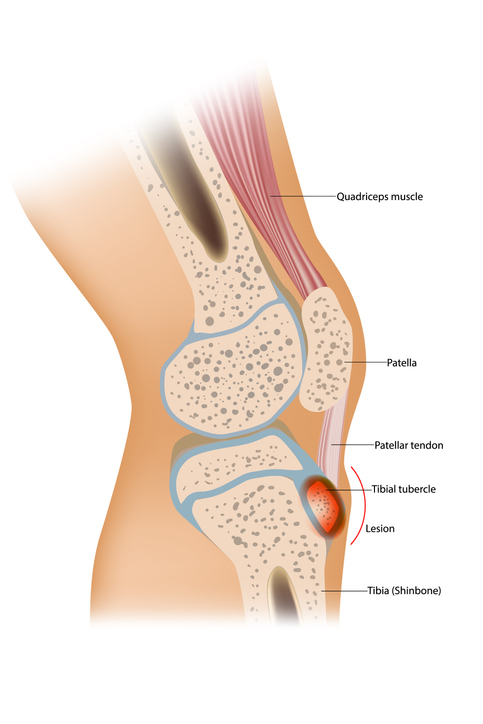 patellar tendinopathy - treatment