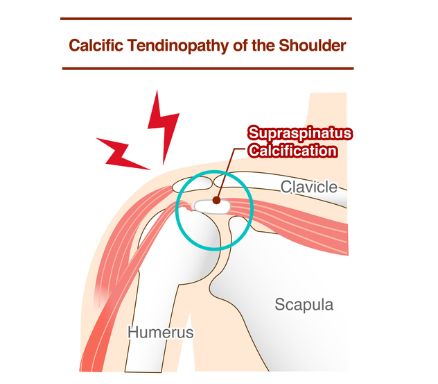 Calcific Tendinopathy of The Shoulder Rotator Cuff